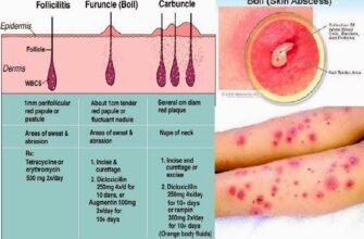 boil-what-does-it-look-like-stages-and-treatment