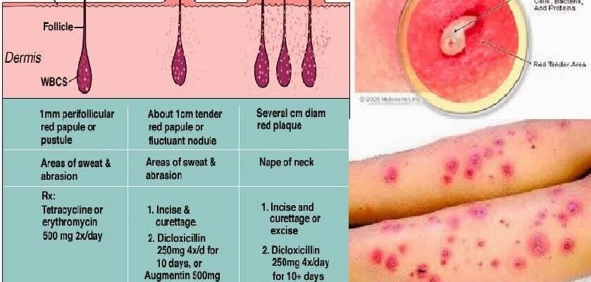 boil-what-does-it-look-like-stages-and-treatment