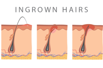 ingrown-hair-what-does-it-look-like-signs-and-treatment